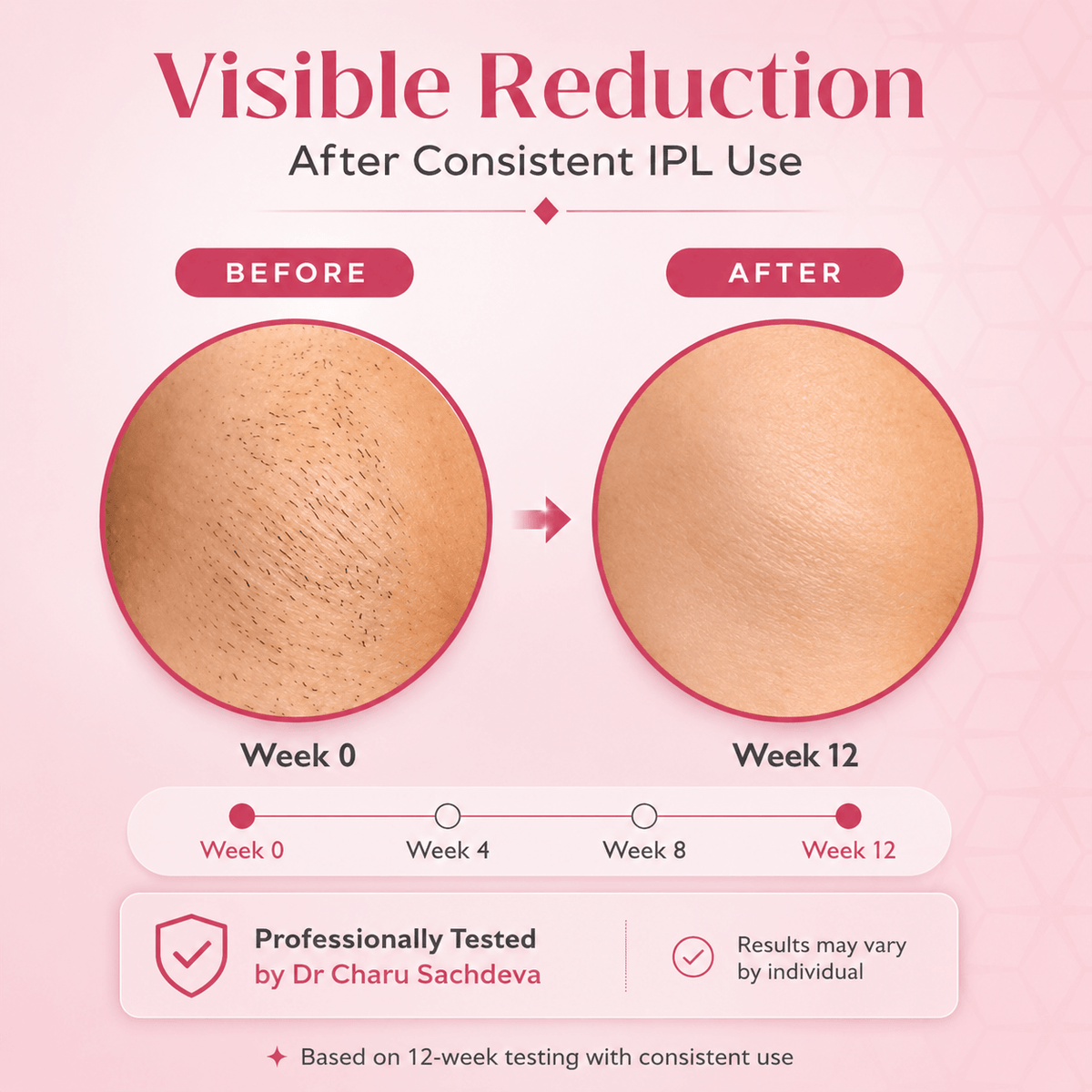 Ovelix SilkGlow™ IPL Hair Remover
